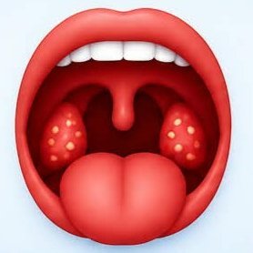 Tonsillitis --- टॉन्सिलाइटिस